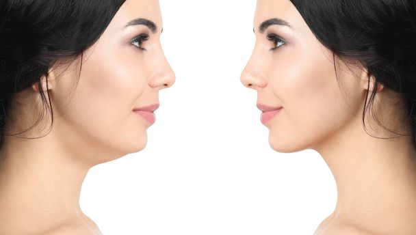 Double chin problem. Collage with photos of young woman before and after plastic surgery procedure on white background - Foto, Imagem