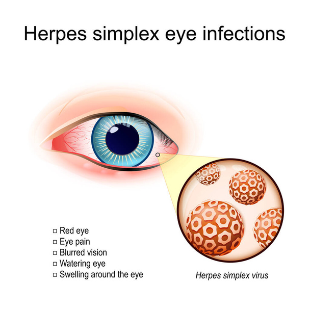 Herpes simplex silmätulehdukset. Punaisen silmän, jossa on turvotusta. lähikuva Herpes simplex viruksesta. virionit, jotka aiheuttivat silmätulehduksen. vektorikuvaus - Vektori, kuva