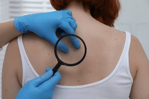 Dermatologist examining patient's birthmark with magnifying glass in clinic, closeup view - Photo, image