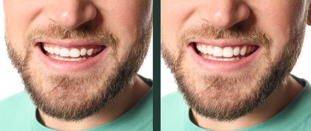 Young man before and after gingivoplasty procedure, closeup. Banner design - Fotó, kép