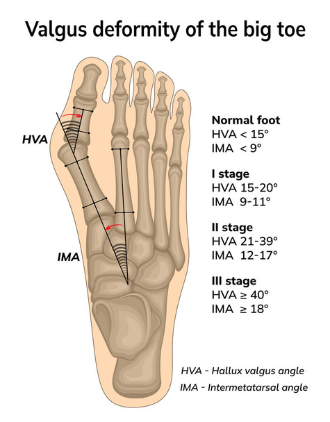 Ilustrace valgus deformity palce. Úhly posuvu kosti během deformace jsou zobrazeny - Vektor, obrázek