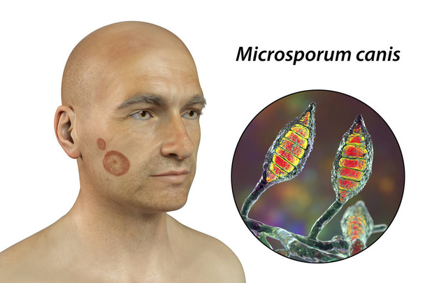 Microsporum canis fungal infection on a man's face and close-up view of Microsporum canis fungi, 3D illustration. Ringworm, Tinea faciei - Photo, Image