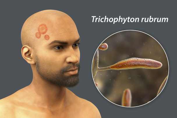 Pilzinfektion auf Kopf und Gesicht eines Mannes, 3D-Illustration eines Mannes mit Tinea capitis und Tinea faciei und Nahaufnahme der Pilze Trichophyton rubrum - Foto, Bild