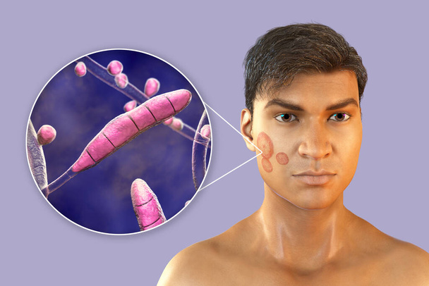 Fungal infection on a man's face, 3D illustration of a man with Tinea faciei and close-up view of fungi Trichophyton rubrum - Photo, Image
