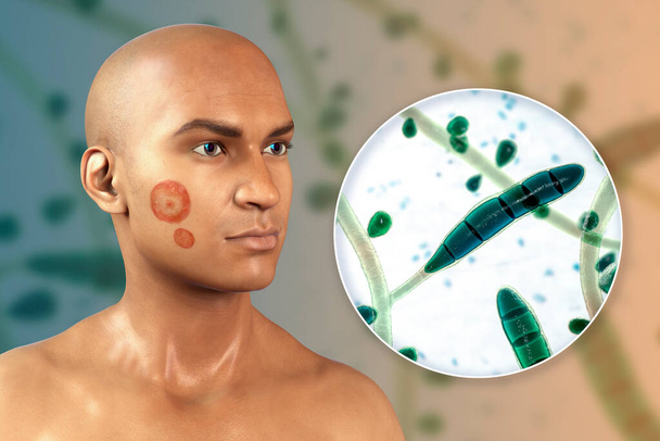 Pilzinfektion im Gesicht eines Mannes, 3D-Illustration eines Mannes mit Tinea faciei und Nahaufnahme des Pilzes Trichophyton rubrum - Foto, Bild