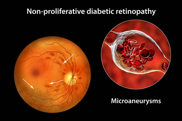 Nieproliferacyjna retinopatia cukrzycowa, ilustracja 3D pokazująca liczne mikrotętniaki na siatkówce oka i widok z bliska na mikrotętniaki, mikroskopowe wybrzuszenia w ścianach tętnic wypełnione krwią - Zdjęcie, obraz