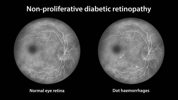 Non-proliferative diabetic retinopathy, ophthalmoscope view, illustration showing normal eye retina and retina with multiple dot haemorrhages (dark grey dots) - Foto, immagini
