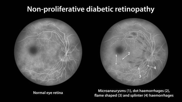 Nieproliferacyjna retinopatia cukrzycowa, ilustracja przedstawiająca prawidłową siatkówkę oka i siatkówkę z mikrotętniakami, krwotoki punktowe, krwotoki siatkówkowe w kształcie płomienia i drzazgi, angiografia fluoresceiny - Zdjęcie, obraz