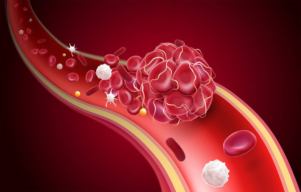 3D illustratie van een bloedstolsel in een bloedvat met een geblokkeerde bloedstroom met bloedplaatjes en witte bloedcellen in het beeld. - Vector, afbeelding