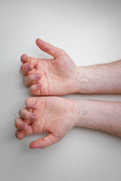 Patient showing arms and palms with red itchy painful rash. Allergic symptom on male hands. Dermatology, skin care. White background, top view. - Foto, Imagem