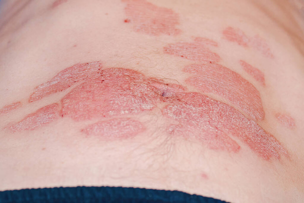Red redness, spots on the skin.Large red inflamed scaly rash on the stomach. Acute psoriasis on the stomach in a man, severe redness on the skin, an autoimmune incurable dermatological skin disease. - Fotó, kép