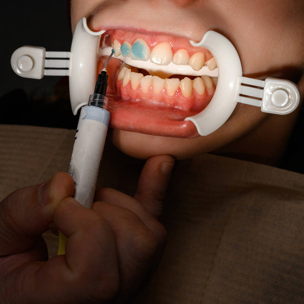 Пластиковий рефрактор для збільшення губ у роті, зубна процедура та рефрактор як допоміжний елемент, наноситься гель на зуби
. - Фото, зображення