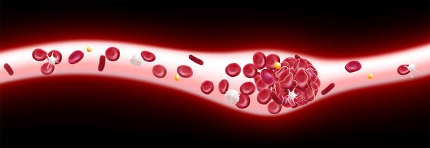 3D illustration of a blood clot in a blood vessel showing a blocked blood flow with platelets and white blood cells in the image. - Vector, Image