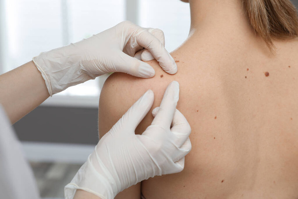 Dermatologist examining patient's birthmark in clinic, closeup view - Foto, imagen