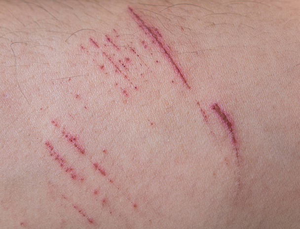 Scratches wound on the skin. - Φωτογραφία, εικόνα