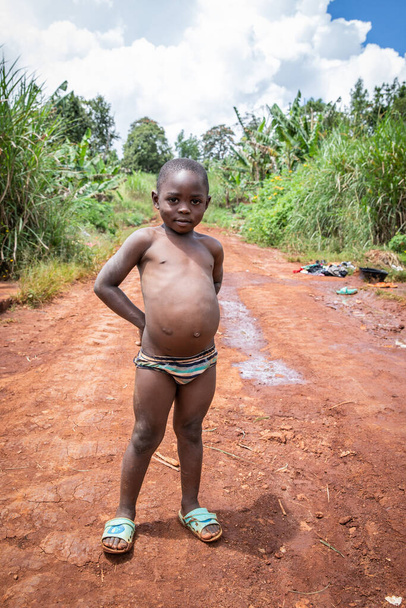 Afrykańskie dziecko cierpiące na Kwashiorkor. Jego brzuch jest spuchnięty przez niedożywienie.. - Zdjęcie, obraz