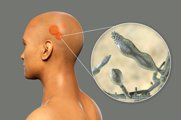 Fungal infection on a man's head, 3D illustration of a man with Tinea capitis and close-up view of fungi Microsporum audouinii - Photo, Image