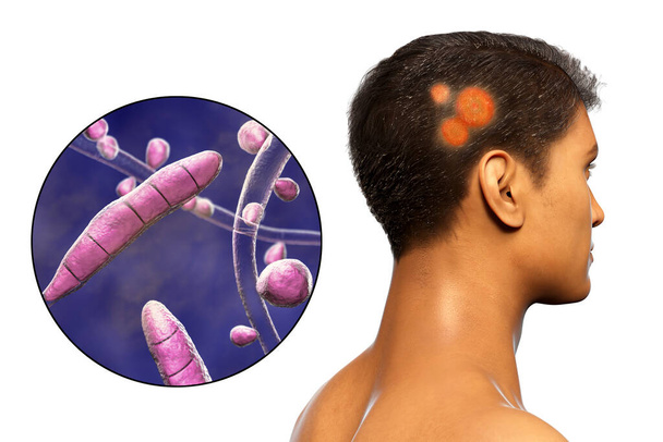 Fungal infection on a man's head, 3D illustration of a man with Tinea capitis and close-up view of fungi Trichophyton rubrum - Photo, Image