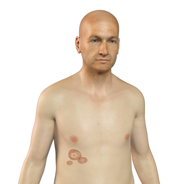 Fungal infection on a man's body. Tinea corporis, 3D illustration - Photo, Image