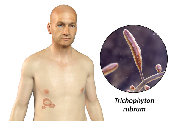 Infección fúngica en el cuerpo de un hombre. Tinea corporis y vista de cerca de hongos dermatofitos Trichophyton rubrum, ilustración 3D - Foto, Imagen