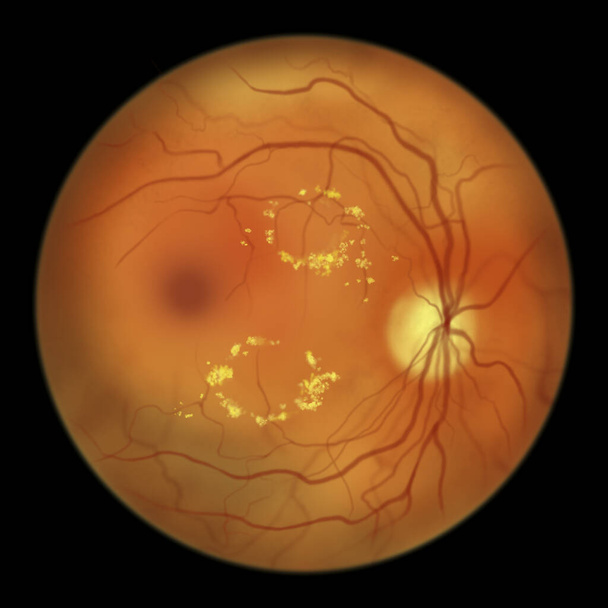 Non-proliferative diabetic retinopathy, illustration showing hard exudates (irregularly shaped yellow spots) on funduscopic examination of the eye retina - Foto, immagini