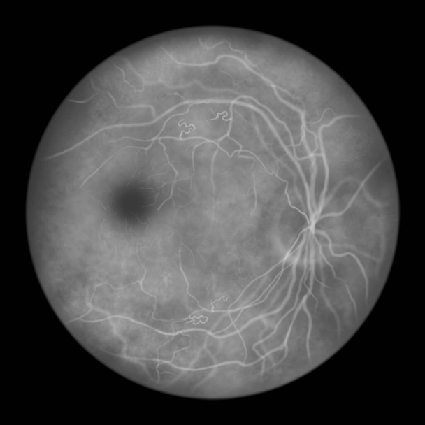 Non-proliferative diabetic retinopathy, illustration showing IRMAs (intraretinal microvascular abnormalities) as small vessels with abnormal branching or dilatation in ischaemic areas, fluorescein angiography - Foto, immagini