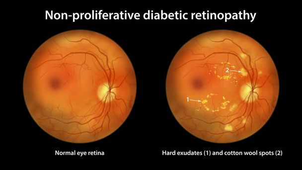 Non-proliferative diabetic retinopathy, illustration showing normal eye retina and retina with hard exudates, and cotton wool spots - Foto, immagini