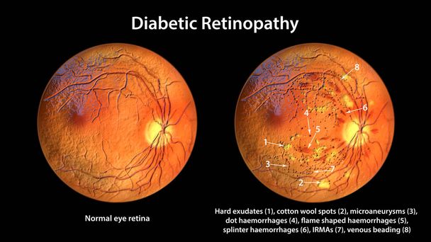 Diabeteses retinopathia non-proliferatív, 3D illusztráció azt mutatja, kemény váladék, pamut gyapjú foltok, mikroaneurizma, pont vérzés, láng alakú és szálka retina vérzés, IRMA-k, vénás gyöngyözés - Fotó, kép