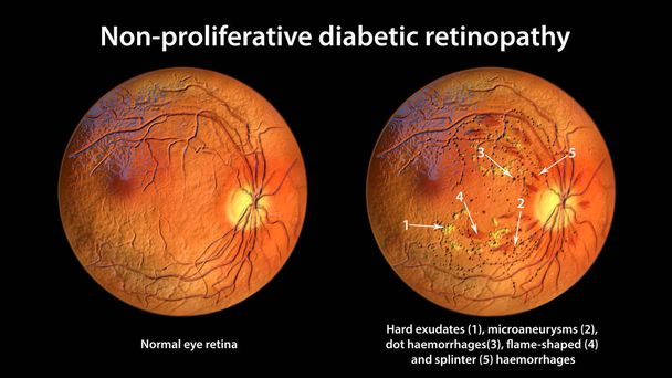Непроліферативна діабетична ретинопатія, 3D ілюстрація, що показує нормальну сітківку ока та сітківку з жорсткими ексудатами, мікроаневризмами, точковими кровотечами, вогнеподібною формою та сплінтерними кровотечами сітківки
 - Фото, зображення