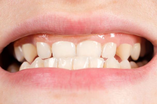 Patient with gingival smile, large gums and small teeth, microdentia, close-up - 写真・画像