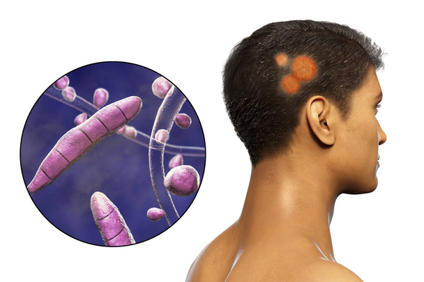 Fungal infection on a man's head, 3D illustration of a man with Tinea capitis and close-up view of fungi Trichophyton rubrum - Фото, изображение