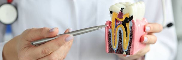 Doctor mostrando carious cavidad con bolígrafo en plástico modelo de diente artificial primer plano - Foto, Imagen