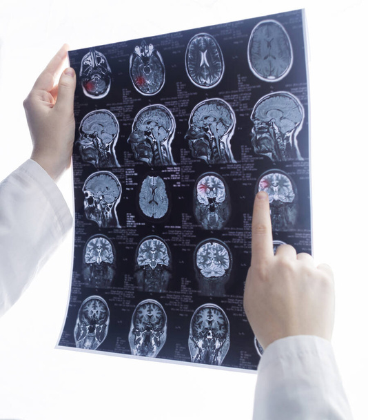 Epileptologist examines patient MRI and electroencephalogram. Concept treating epilepsy and helping people who suffer from this disease. Neurologist at work. Pathology of the brain. Seizure activity - Foto, Imagem