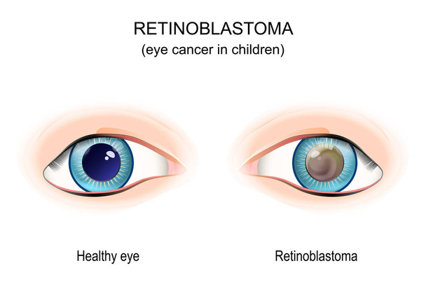 Ρετινοβλάστωμα. καρκίνος του οφθαλμού στα παιδιά. σύγκριση υγιών οφθαλμών και λευκοκορίας. μάτι με κληρονομικό γενετικό ελάττωμα. Εικονογράφηση διανύσματος - Διάνυσμα, εικόνα