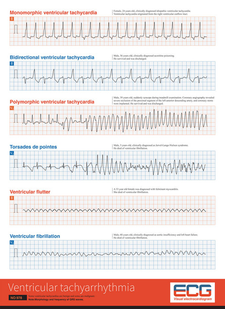 Ventricular tachyarrhythmia includes many clinical types, some benign and some malignant. For malignant ventricular arrhythmias, patients are at risk of death. - Foto, immagini