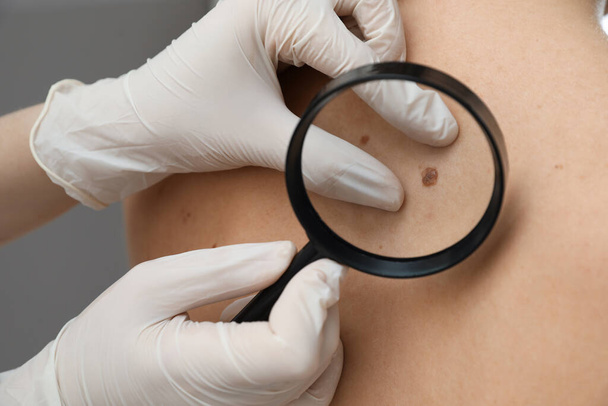 Dermatologist examining patient's birthmark with magnifying glass in clinic, closeup view - Photo, Image