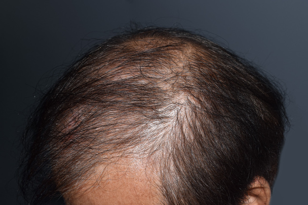 diradamento o capelli radi, perdita di capelli modello maschile nel sud-est asiatico, uomo anziano cinese. - Foto, immagini