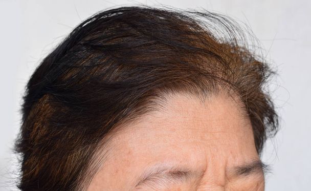 Huidrimpels of rimpels op het voorhoofd van Zuidoost-Aziatische, Myanmar of Birmaanse oudere vrouw. Symptoom van veroudering. - Foto, afbeelding