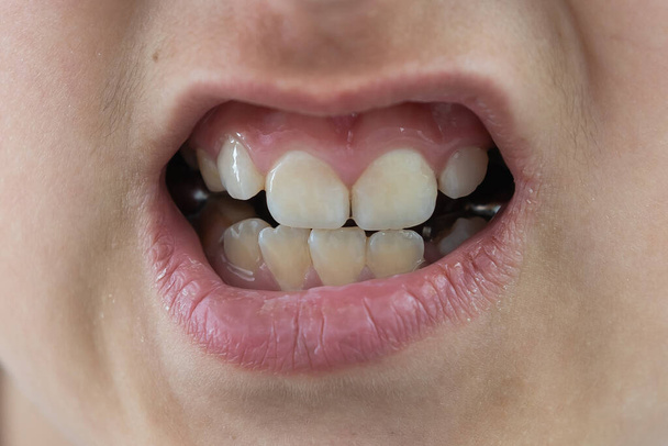Ενήλικες μόνιμα δόντια που έρχονται μπροστά από τα παιδικά δόντια: δόντια καρχαρία. Μικρά κορίτσια ανοίγουν το στόμα. σε οδοντογιατρό. πρόβλημα. - Φωτογραφία, εικόνα