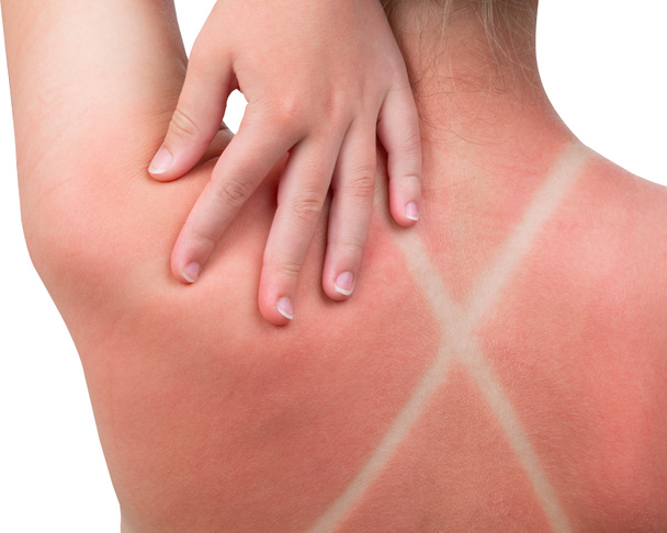 Sunburn. Girl got a Sunburn. Red painful skin on back that feels hot to the touch after beach visits. Use Sunscreen or UV protection cream. Summer vacation on ocean beach. White Isolated background. - Photo, image
