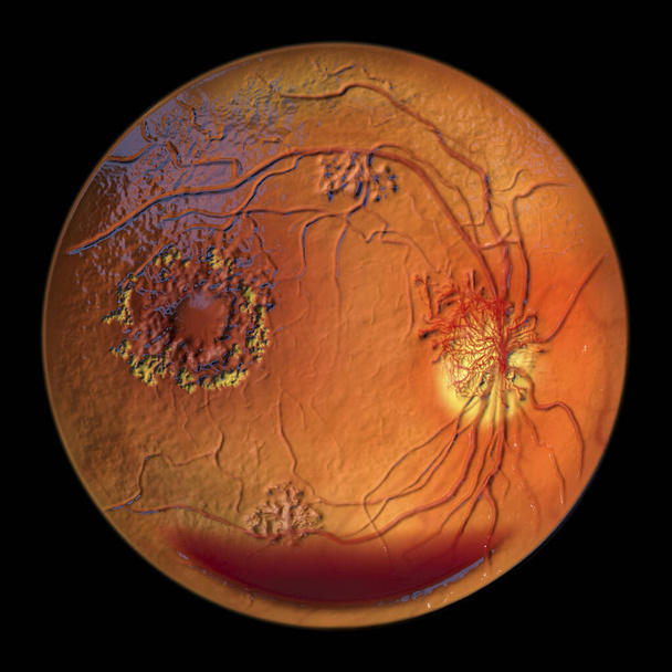 Proliferatív diabéteszes retinopathia, 3D-s illusztráció, amely a preretinális vérzést horizontális vérszintként, a lemez és más helyek neovaszkularizációját, macula ödémát és kemény váladékokat mutatja - Fotó, kép