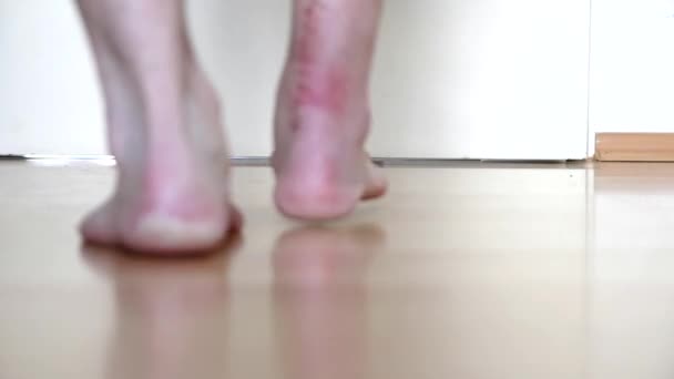 European man first steps after Achilles tendon rupture operation shows wound suture in the hospital showing stitches and operation transection walks barefoot with pain and partial weight bearing PWB - Záběry, video