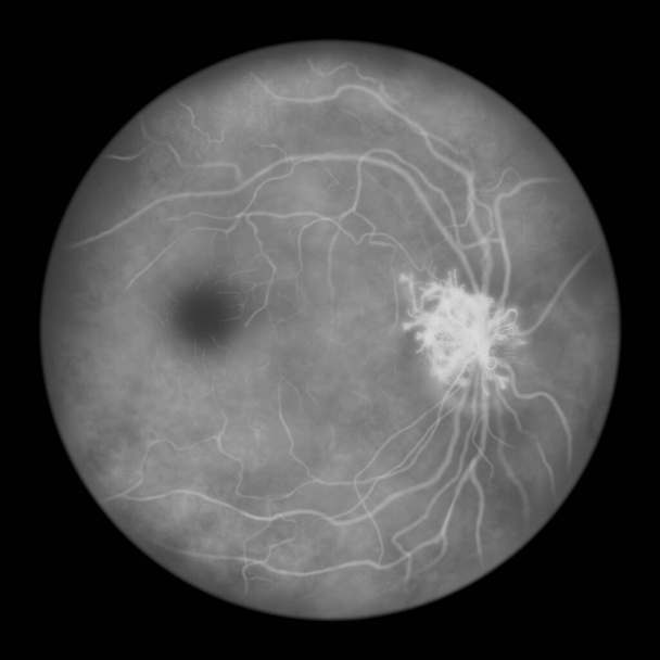 Proliferative diabetic retinopathy, illustration showing neovascularization (formation of new vessels) in the optic disk. Eye retina in diabetes mellitus, fluorescein angiography - Fotó, kép