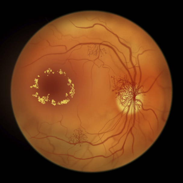 Проліферативна діабетична ретинопатія, ілюстрація, що показує неоваскуляризацію в диску та інших місцях, набряк макули та жорсткі ексудати. Фантоскопічне дослідження сітківки ока при цукровому діабеті
 - Фото, зображення