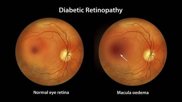 糖尿病性黄斑変性(DME) 、通常の眼網膜を示し、黄斑変性を示すイラスト。糖尿病における眼網膜の眼底検査 - 写真・画像