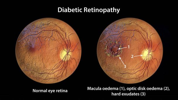 Retinopatia cukrzycowa, ilustracja 3D pokazująca obrzęk plamki żółtej, obrzęk dysku wzrokowego i twarde wysięki, nieprawidłowe wyniki badania fundoskopowego siatkówki oka w cukrzycy - Zdjęcie, obraz