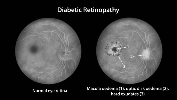 Diabetic retinopathy, illustration showing cystoid macula edema, optic disk oedema and hard exudates, fundoscopic examination of the eye retina in diabetes mellitus, fluorescein angiography - Foto, immagini