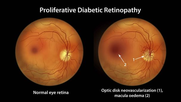 Proliferative diabetic retinopathy, illustration showing neovascularization in the disk and macula edema. Abnormal finding on fundoscopic examination of the eye retina in diabetes mellitus - Foto, immagini