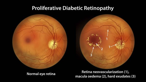 Proliferatiivinen diabeettinen retinopatia, kuva osoittaa neovaskularisaatio levyllä ja muilla sivustoilla, makulan turvotus ja kova exudates. Silmän verkkokalvon fundoskooppinen tutkimus diabetes mellituksessa - Valokuva, kuva