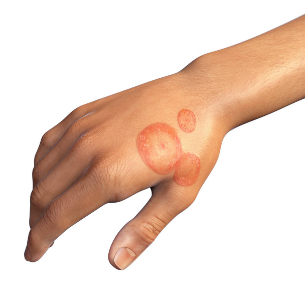 Infección fúngica en la mano de un hombre. Tinea manuum, ilustración 3D - Foto, Imagen